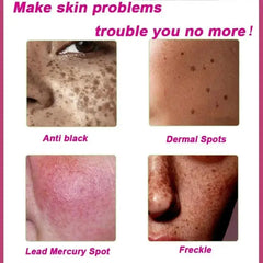 Whitening Freckles Serum Cream to Remove Dark Spots