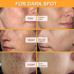 Whitening Freckles Serum Cream to Remove Dark Spots