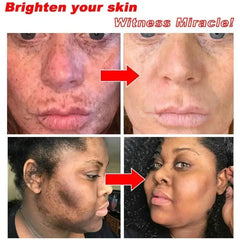 Whitening Freckles Serum Cream to Remove Dark Spots