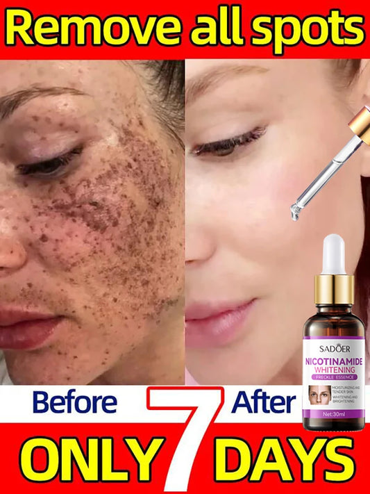 Whitening Freckles Serum Cream to Remove Dark Spots